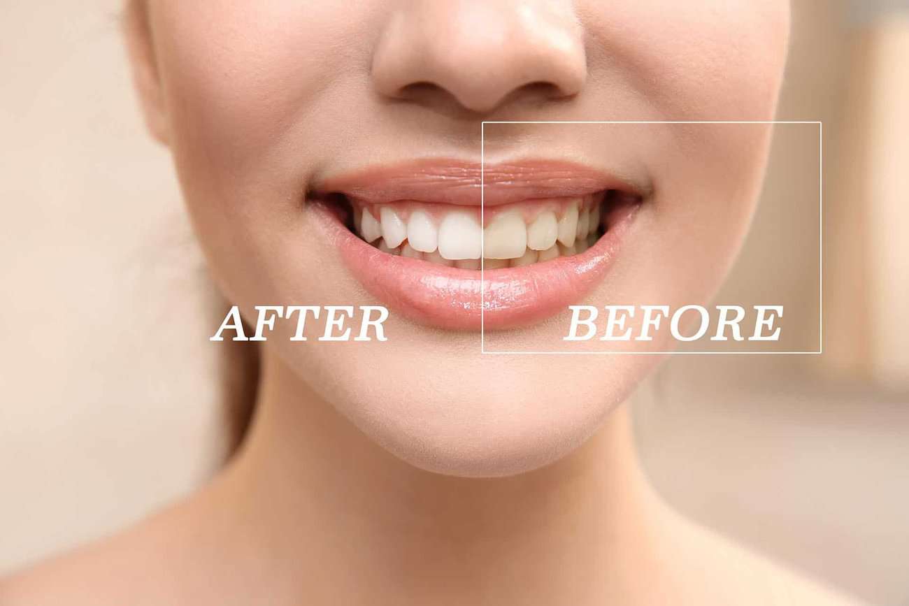 How Can You Maintain a Consistent Smile Shade with Crowns Winchester?
