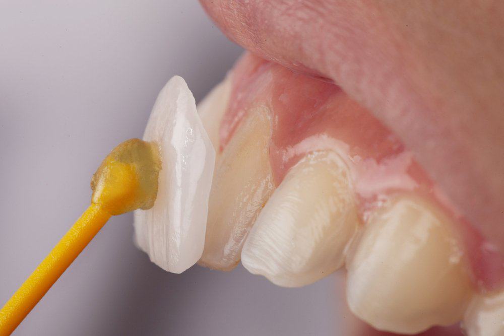 Dental Veneers: Achieving a Flawless Look Winchester