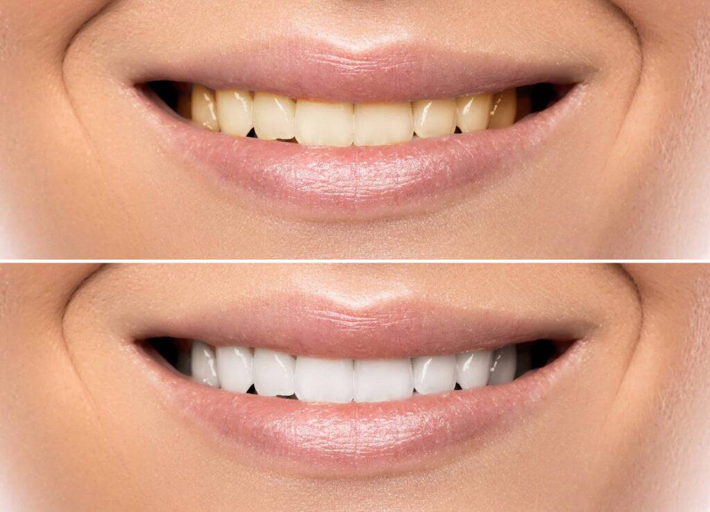 How Does Gum Disease Progress if Left Untreated Winchester?