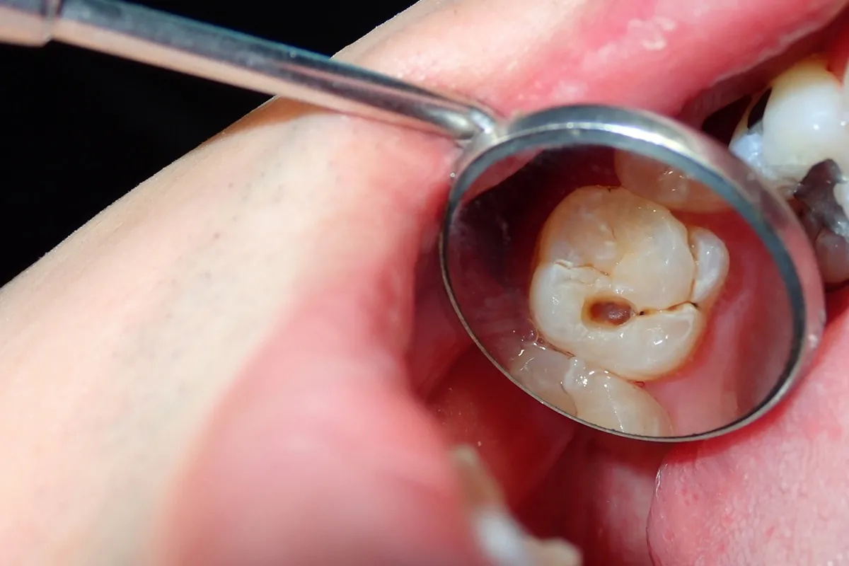 Why Do Teeth Crack? Common Causes to Know Winchester