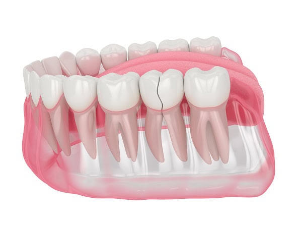 How Can You Manage Pain and Discomfort After a Root Canal Winchester?