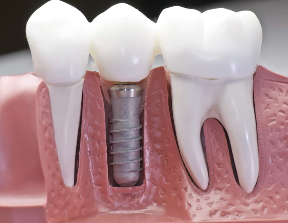 Common Misconceptions About Modern Dental Treatments Winchester