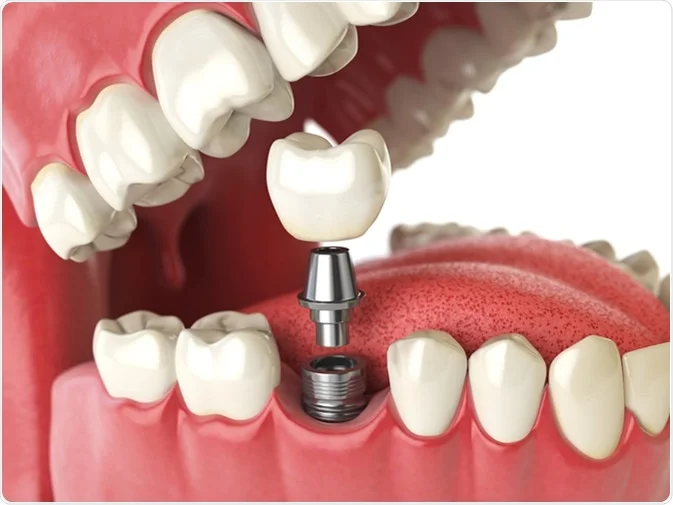 How Do I Decide Which Tooth Replacement Is Right for Me Winchester?