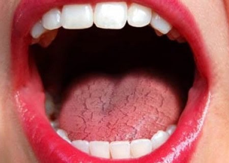 Common Causes of Dry Mouth (Xerostomia) Winchester