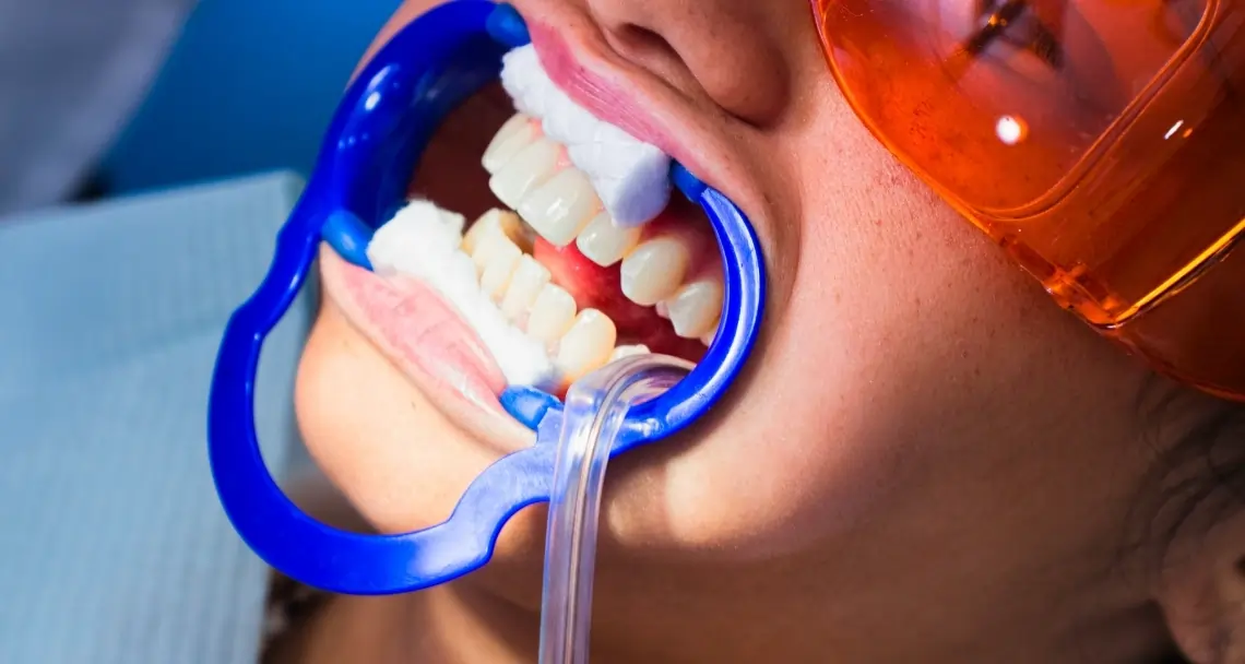 How Teeth Whitening Treatments Actually Work on Your Enamel Winchester