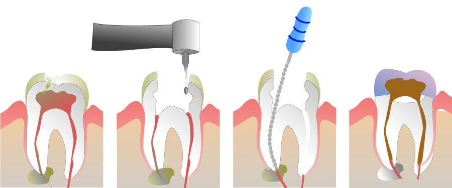 How Do You Properly Care for Your Teeth After a Root Canal Winchester