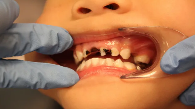 Which Foods and Drinks Cause the Most Damage to Young Smiles Winchester?