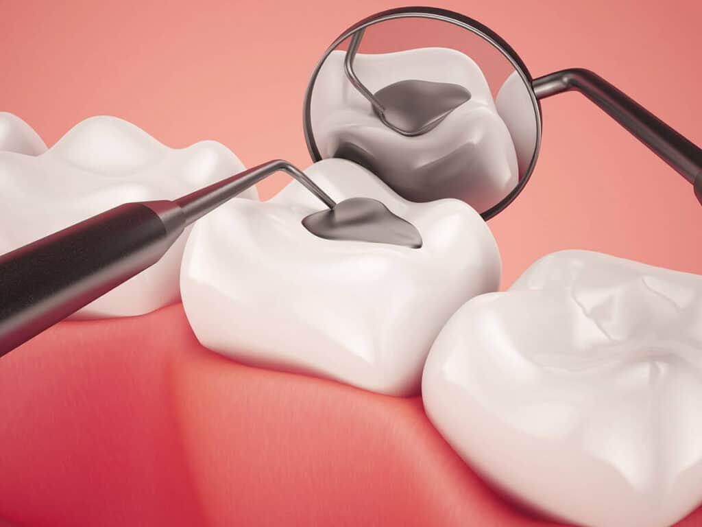 Fighting Cavities and Plaque Buildup Winchester