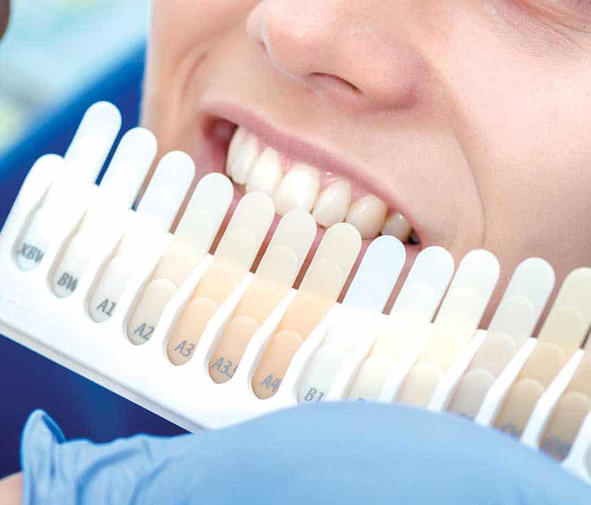 Is Laser Teeth Whitening Worth It for a Brighter, Confident Smile Winchester?