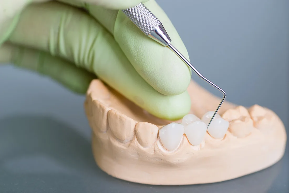 What Are the Different Types of Dental Crowns Available Winchester?