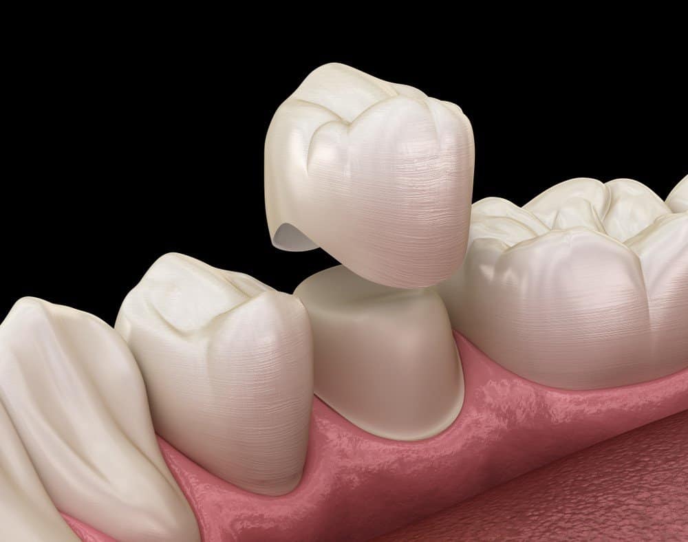 What Daily Habits Help Protect Your Dental Crowns Winchester?